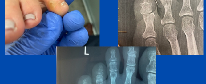 Ankylosed DIPJ and interdigital corn Ankylosed DIPJ and interdigital corn