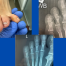 interdigital corn (photo and x-rays); images by Sydney Foot and Ankle Surgeon Damien Lafferty