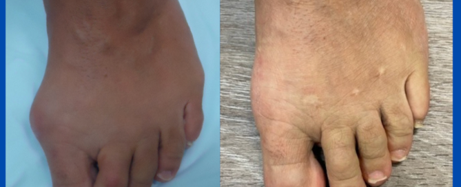 Minimally invasive metatarsal osteotomy (keyhole surgery) Minimally invasive metatarsal osteotomy (keyhole surgery)