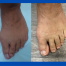 before and after photos of Austin/chevron bunionectomy and correction of plantar plate pathology; images by Sydney Foot and Ankle Surgeon Damien Lafferty