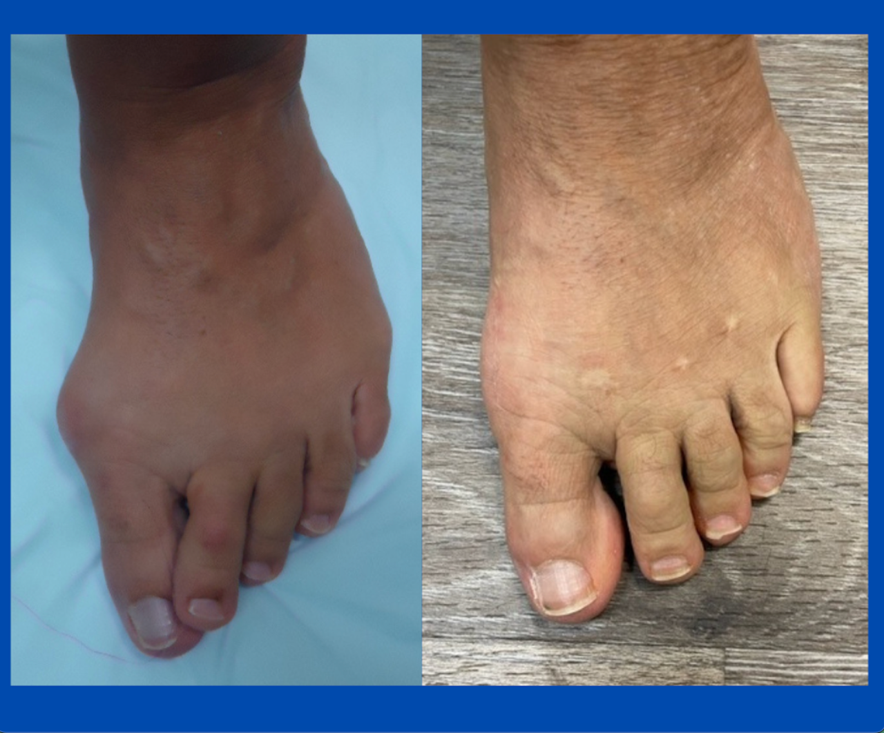 before and after photos of Austin/chevron bunionectomy and correction of plantar plate pathology; images by Sydney Foot and Ankle Surgeon Damien Lafferty