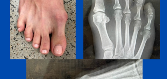 Nerve entrapment from early bunion formation Nerve entrapment from early bunion formation