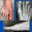 photo and X-rays of foot with bunion; images by Sydney Foot and Ankle Surgeon Damien Lafferty