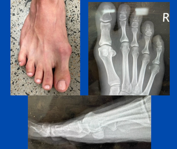 photo and X-rays of a foot with bunion; images by Sydney Foot and Ankle Surgeon Damien Lafferty