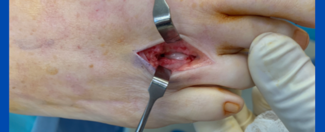 Advances in neuroma surgery Advances in neuroma surgery