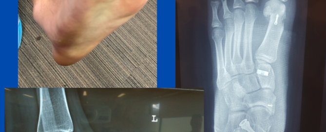 Paediatric rigid flat foot Paediatric rigid flat foot