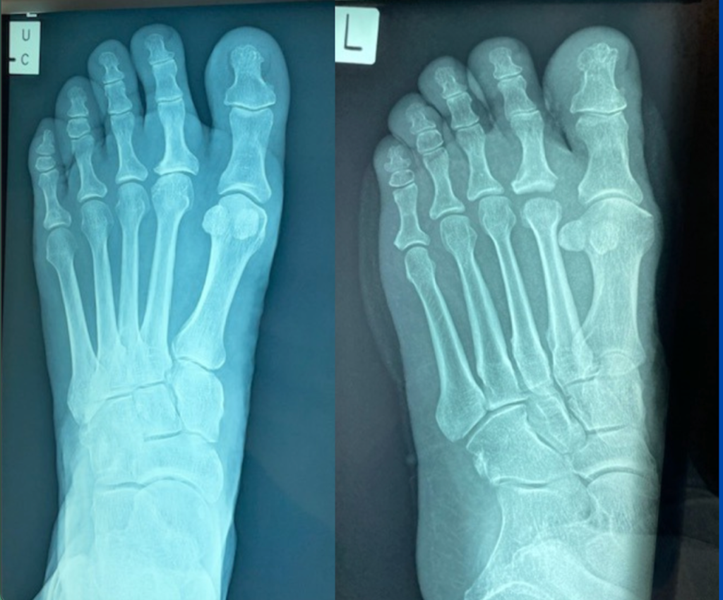 Second MTPJ arthrosis and capsular interpositional arthroplasty