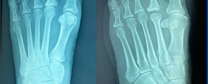Second MTPJ arthrosis and capsular interpositional arthroplasty Second MTPJ arthrosis and capsular interpositional arthroplasty