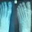 X-rays of a foot with second MTPJ arthrosis (left) and after an arthroplasty (right); images by Sydney Foot and Ankle Surgeon Damien Lafferty