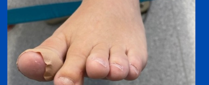 Severed tendon Severed tendon