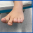 foot with an enlarged 2nd MTPJ; image by Sydney Foot and Ankle Surgeon Damien Lafferty