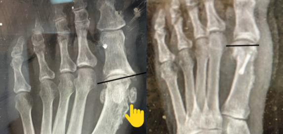 Revisional bunion surgery: subtle points Revisional bunion surgery: subtle points