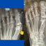 x-Rays showing a foot before (left) and after a bunion surgery performed by Dr Lafferty; images by Sydney Foot and Ankle Surgeon Damien Lafferty
