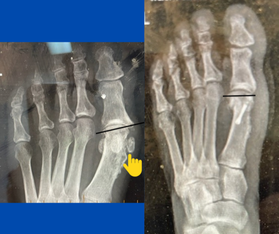 x-Rays showing a foot before (left) and after a bunion surgery performed by Dr Lafferty; images by Sydney Foot and Ankle Surgeon Damien Lafferty