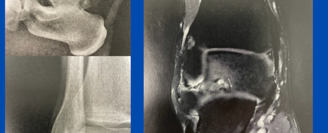 Posterior “ankle pain” Posterior “ankle pain”