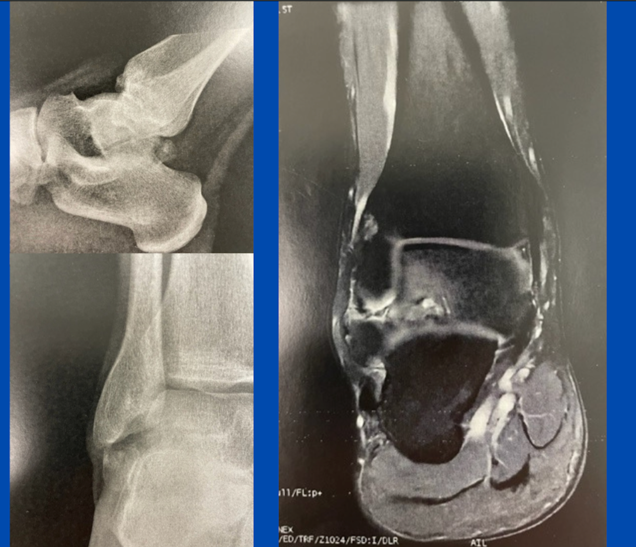 X-ray and MRI imagery showing a patient's ankle; images by Sydney Foot and Ankle Surgeon Damien Lafferty