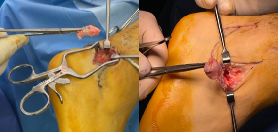Posterior “ankle pain” (intra-operative images) Posterior “ankle pain” (intra-operative images)