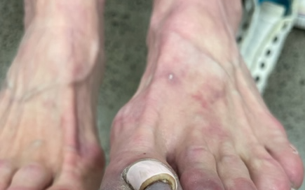 Is it really ingrown toenail? Is it really ingrown toenail?