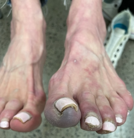 photo taken during an examination of left hallux 'ingrown toenail'; image by Sydney Foot and Ankle Surgeon Damien Lafferty
