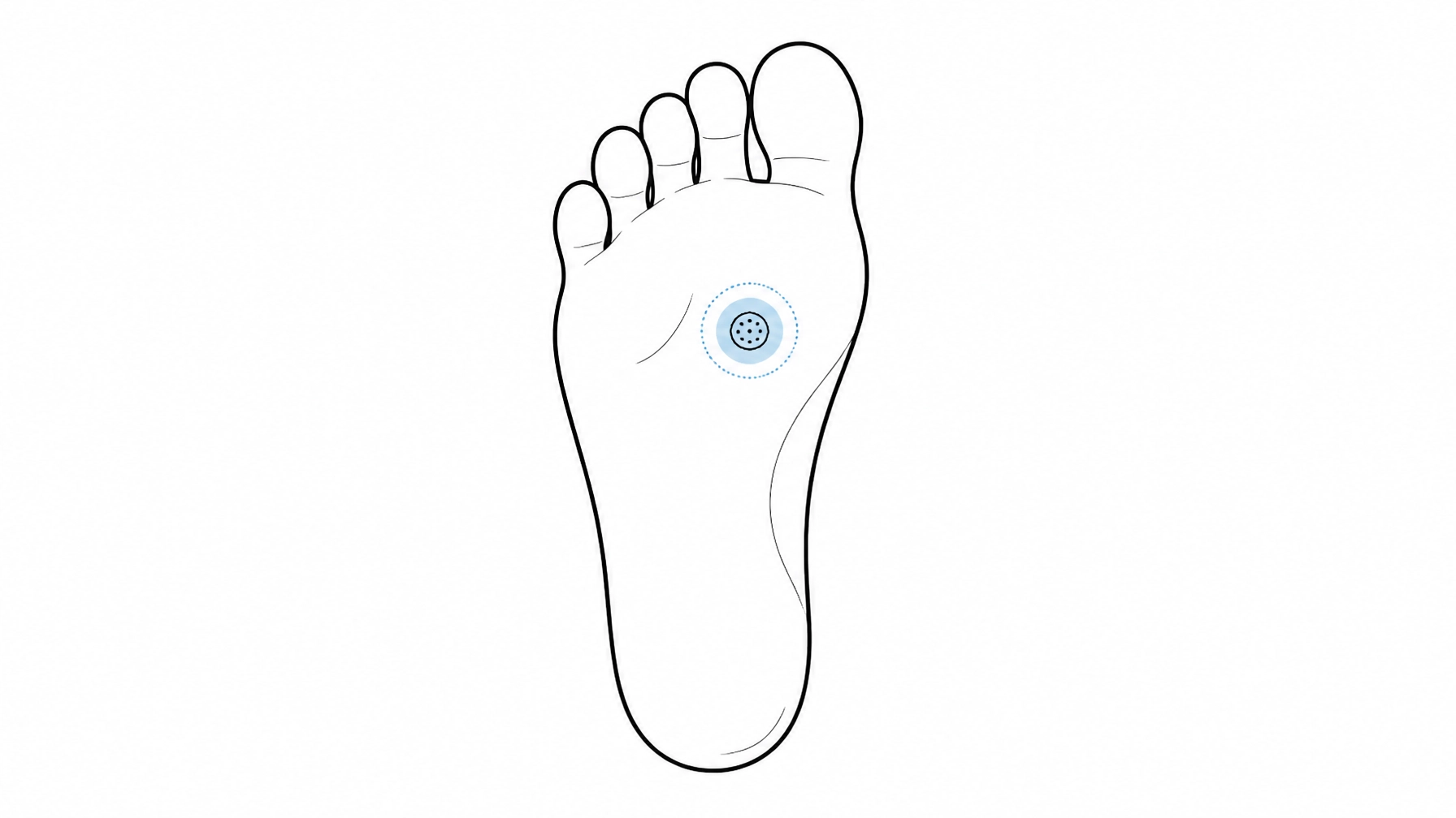 The Specialist Guide to Permanent Wart Removal in Sydney