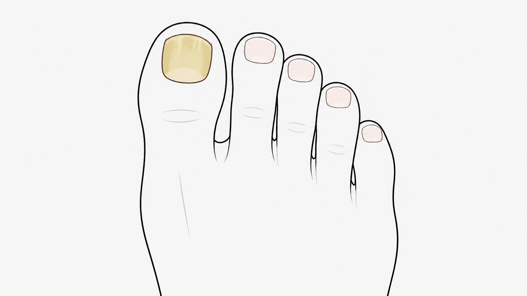 Clearing the Confusion: Why Most Fungal Nail Treatments Fail (and Our 4-Part Solution)