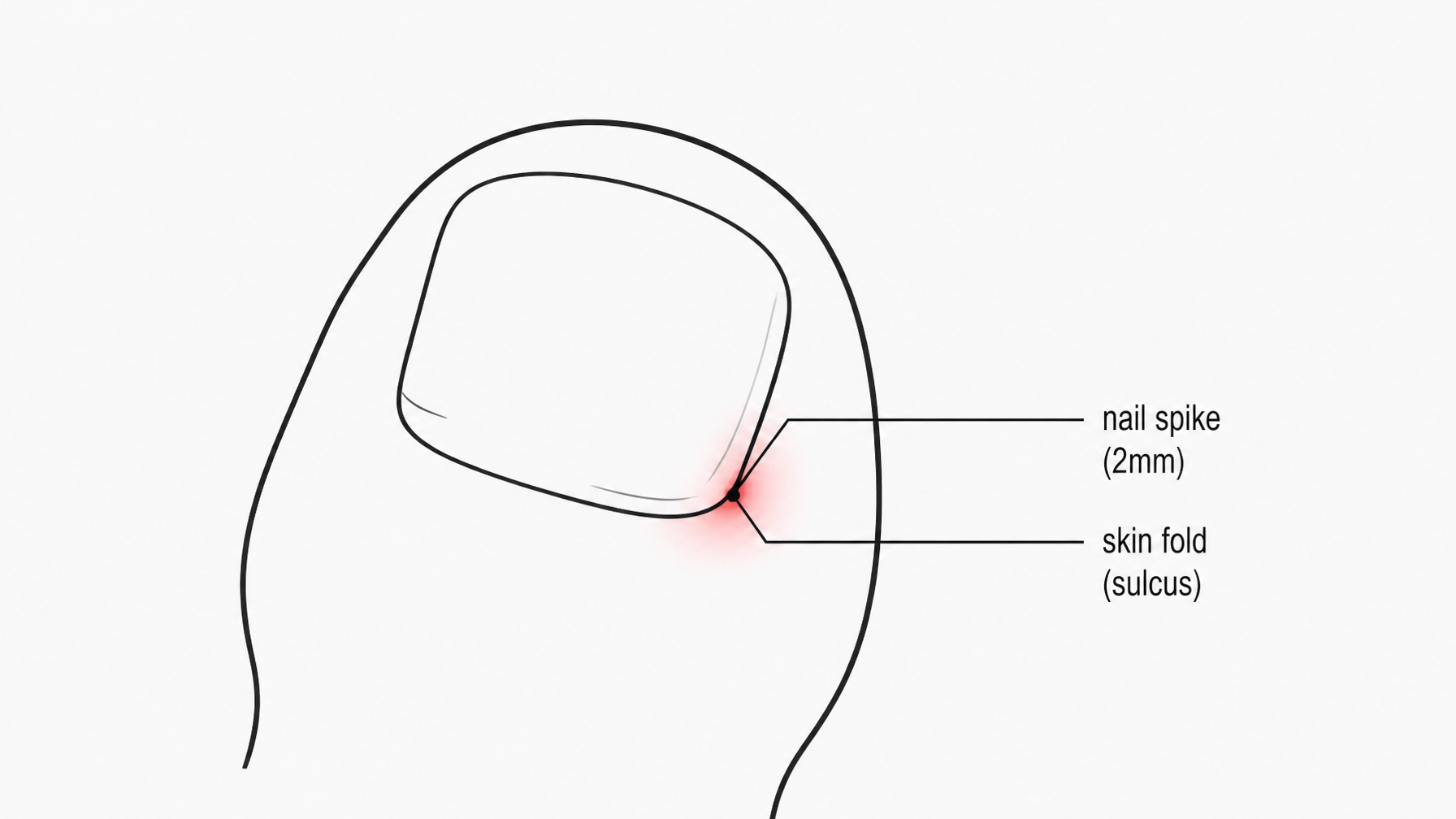 Why Antibiotics Alone Won’t Fix Your Recurrent Ingrown Toenail