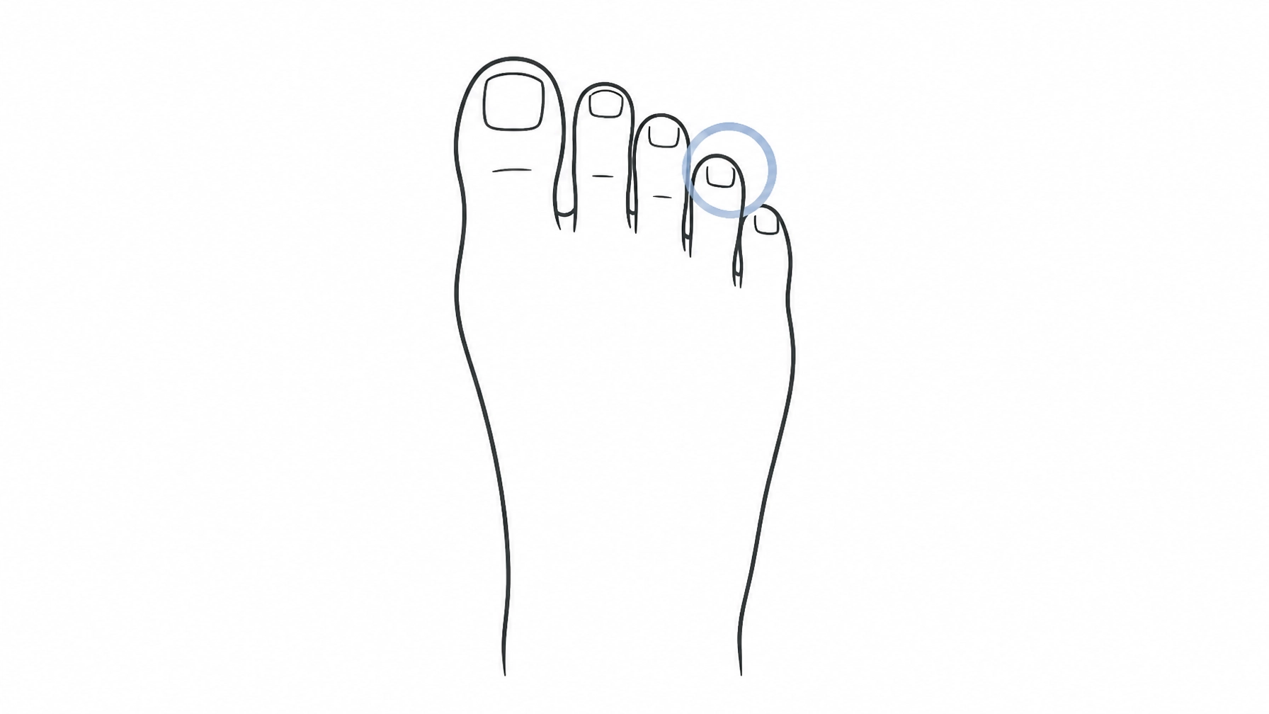 The 4-Part Protocol: Why Your Fungal Nail Treatment is Failing (and How to Fix It)