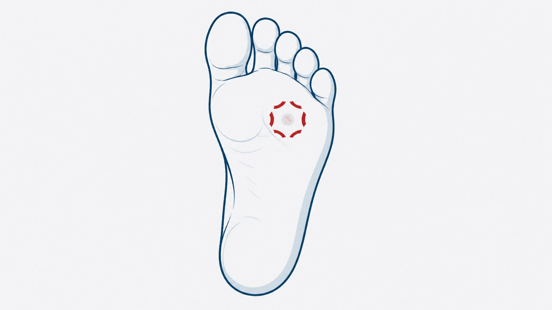 The Specialist Approach to Stubborn Warts When Home Remedies Aren’t Cutting It