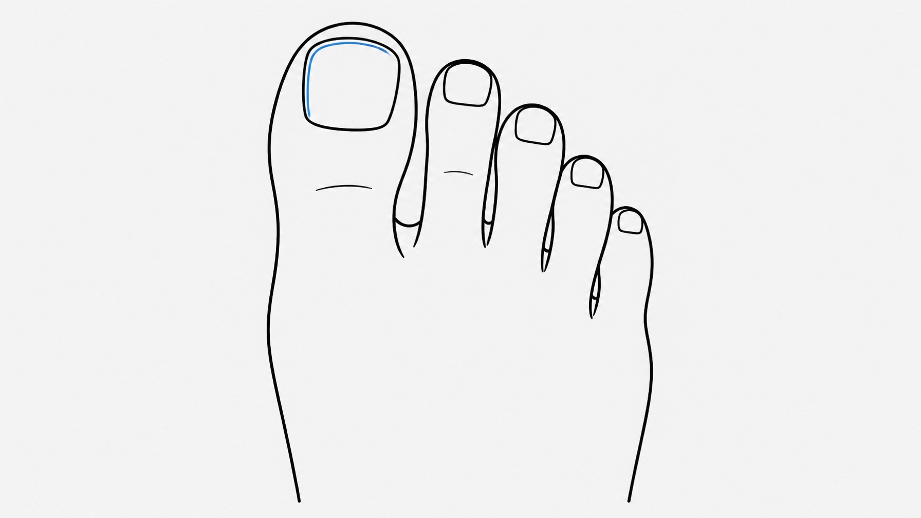 The Definitive Sydney Guide to Ingrown Toenails: Why ‘Bathroom Surgery’ Fails and How to Find Permanent Relief