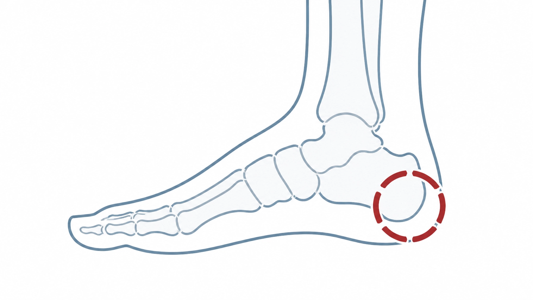 When Shockwave Therapy Fails: Finding Real Relief for Chronic Heel Pain in Sydney